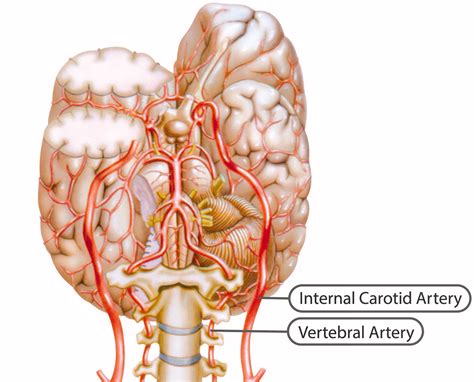 Vertebral Artery Dissection Symptoms