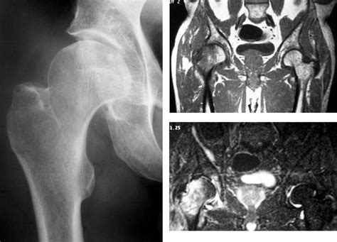Role Of Mri In Hip Fractures Including Stress Fractures Occult