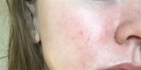 Red Inflamed Pores On Face Acne Symptoms