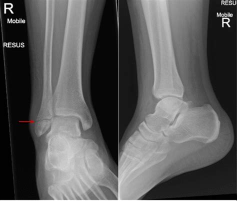 Ankle X Ray Interpretation Ankle Fracture Geeky Medics