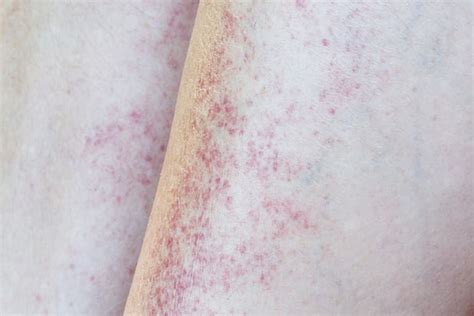 Petechiae What Causes These Tiny Red Blood Spots On Skin