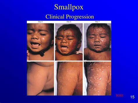 Ppt Smallpox Powerpoint Presentation Free Download Id4030892