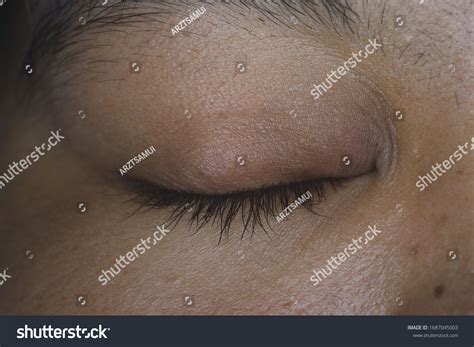Close Stye Hordeolum Chalazion Eyelid Infection Stock Photo 1687045003