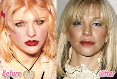 Courtney Love Plastic Surgery Before And After Photos Star Plastic Surgery Before And After In H