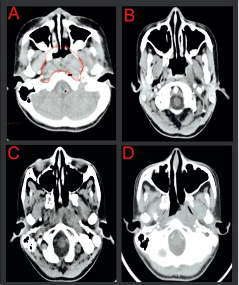 Nasopharynx Ct Anatomy Radiology Anatomy Structure