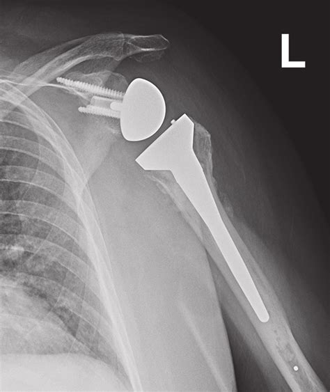 —a 3 Part Proximal Humerus Fracture A With A Displaced Greater