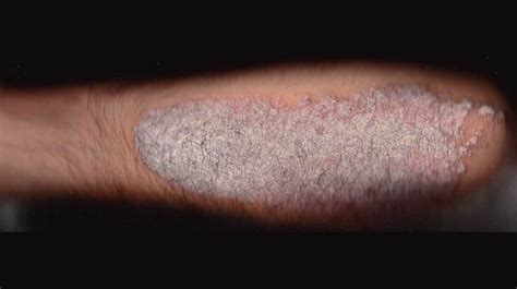 Psoríase Versus Dermatite Seborréica O Que Você Deve Saber Minha Saúde