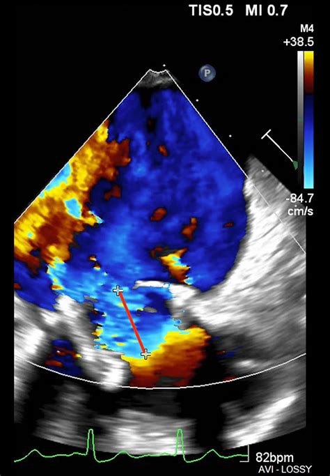 Cureus Premature Bioprosthetic Mitral Valve Dysfunction Due To Flail Leaflet Treated With