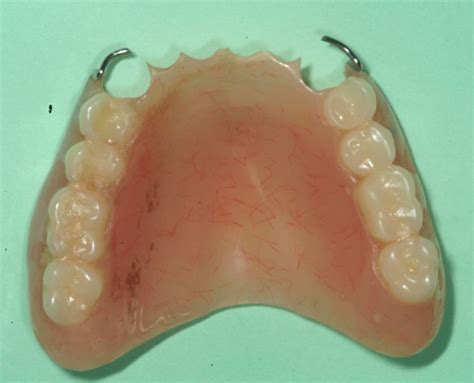 4 Pretreatment Upper Removable Partial Denture Pa Dental Implants
