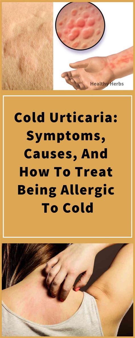 Cold Urticaria Symptoms Causes And How To Treat Being Allergic To