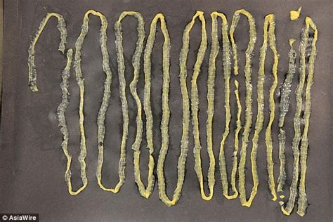 Doctors Pull A 9 Foot Tapeworm From Mans Rectum Daily Mail Online