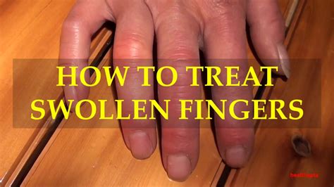 How To Treat Swollen Fingers Youtube