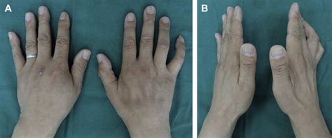 Entrapment Neuropathy of the Wrist, Forearm, and Elbow | Plastic