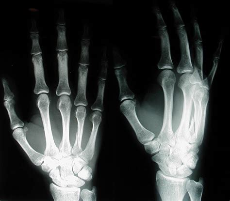 Hand X Rays Related Keywords And Suggestions Hand X Rays Long Tail Keywords