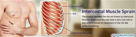 Intercostal Muscle Spraincausessymptomsdiagnosistreatment