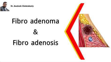 Fibroadenoma Fibroadenosis Dr Anutosh Chakraborty Youtube