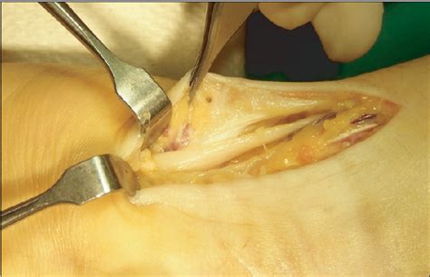 Figure 1 From Ulnar Nerve Palsy Following Closed Fracture Of The Distal