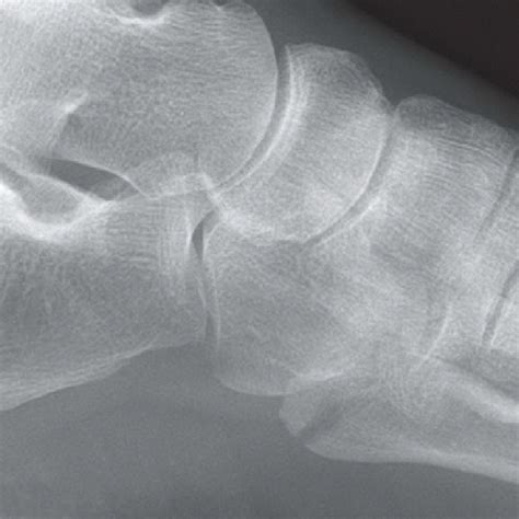 Base of Fifth Metatarsal Fracture | Radiology Key