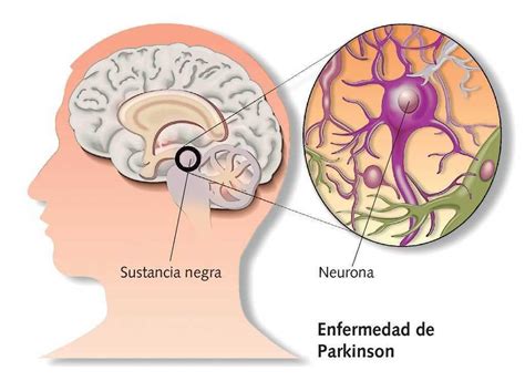 Qu Es La Enfermedad De Parkinson Y C Mo Reconocerla Fisioonline