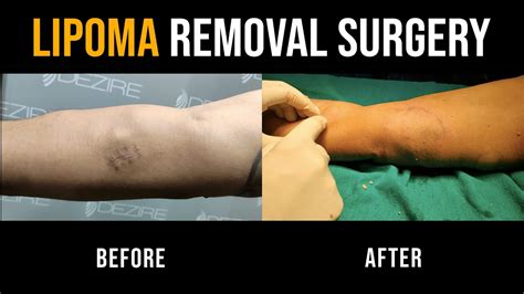 Lipoma Surgery Removal Video Multiple Lipoma Removal Video In Hindi