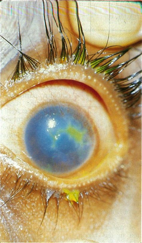 Geographic Type Corneal Ulceration With Vascularisation And Stromal