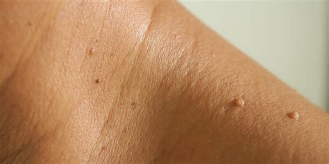 Bumps On The Skin Causes And Treatments
