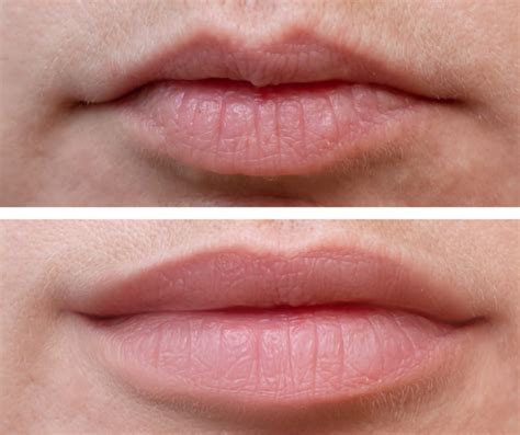 Lips Fillers Before And After Vedas Medical Spa And Wellness Center