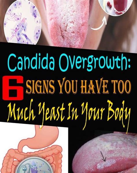 Pin By Be Healthy On Health In 2020 Candida Overgrowth Candida Health