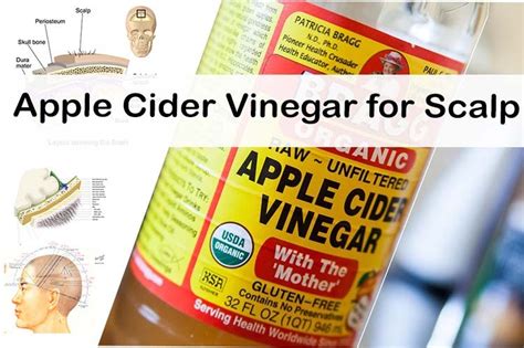 Homekit is all over the. Apple Cider Vinegar for Dry Itchy Scalp and Psoriasis ...