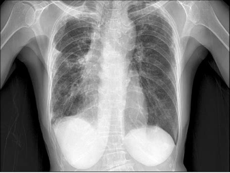 Chest Radiograph Shows Multifocal Consolidations And Reticulonodular