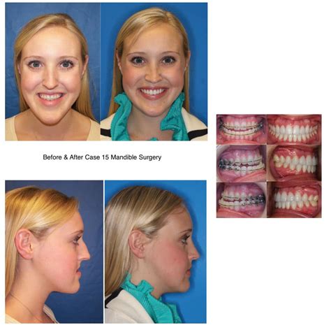 Before And After Mandible Corrective Jaw Surgery Girl Dr Larry M