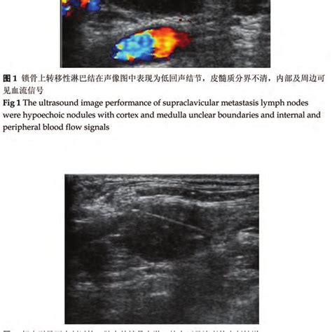 The Ultrasound Image Performance Of Supraclavicular Metastasis Lymph
