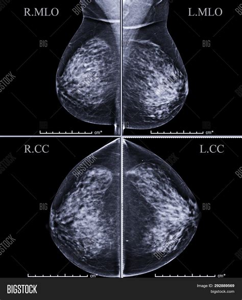 Digital Mammogram Both Image And Photo Free Trial Bigstock