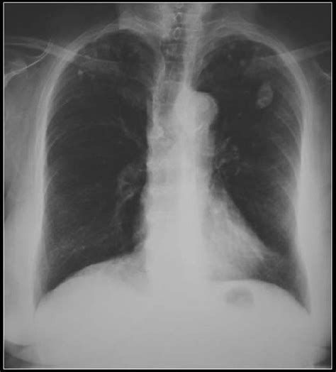 Calcification On Chest X Ray