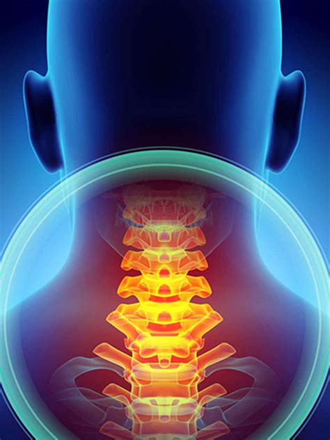 Cervical Stenosis Cervical Stenosis Myelopathy Cervical Back Pain