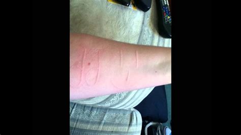 Dermatographic Urticaria Also Known As Skin Writing Youtube