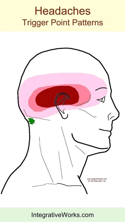 Headache Location Chart In 2020 Headache Back Of Head Trigger Points