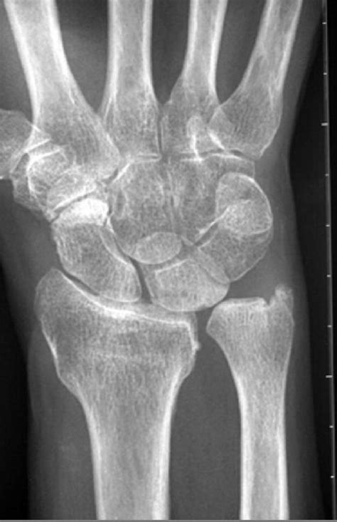 Positive ulnar variance with TFCC tear | Image | Radiopaedia.org