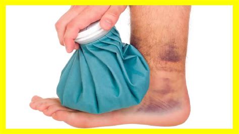 Como Curar Hematomas Rápidamente Soft Tissue Injury Sprained Ankle