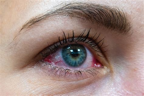 Eye Allergies Overview Eye Patient