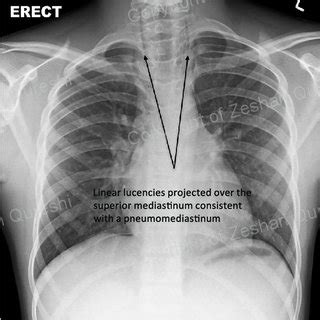 Understanding chest wall anatomy is paramount to any surgical procedure regarding the chest and is vital to any reco. (PDF) The Unofficial Guide to Radiology