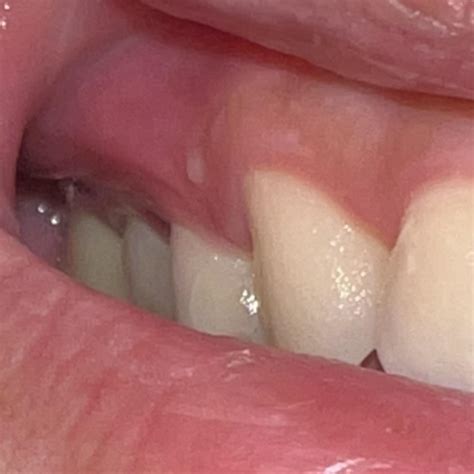 Painless Circular White Bump On Gums Persisting For 2 Months Stayed