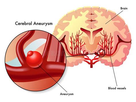 A cerebral or intracranial aneurysm is an abnormal focal dilation of an artery in the brain that results from a weakening of the inner muscular layer (the intima) of a blood vessel wall. Cerebral aneurysm stock vector. Illustration of bulge ...