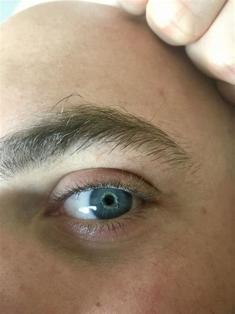 Ive Always Had This White Ring Around My Pupil Does Anyone Know What
