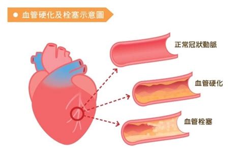 Learn more about coronary artery disease (cad), one of australia's leading causes of death. 心因性休克分秒奪命 血管彈性要這樣保養才有用 | 匯流新聞網