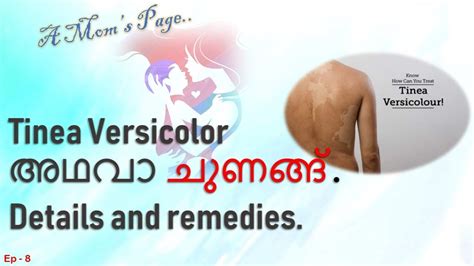 Tinea Versicolor Or Pityriasis Versicolor Details And Remedies Youtube