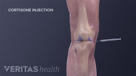 How To Give A Testosterone Shot In Your Thigh