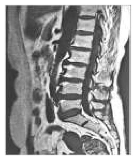 Mri Image Reconstruction Results Of Lumbar Nerves By The Three