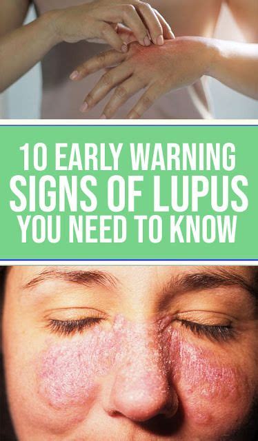 10 Early Warning Signs Of Lupus You Need To Know Wellness Topic