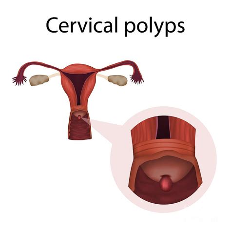 What Are Cervical Polyps Cervical Polyp Cervix My Xxx Hot Girl